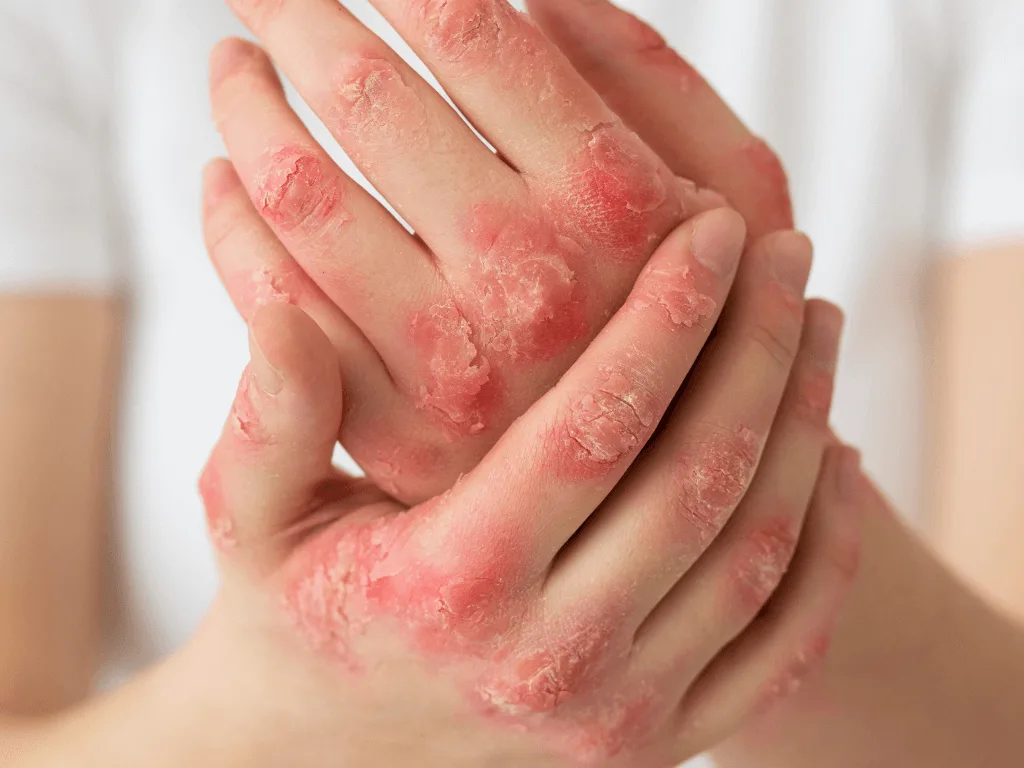 hands-patient-suffering-from-psoriasis